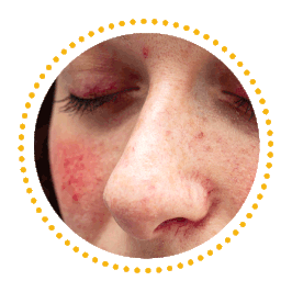 Rosacea