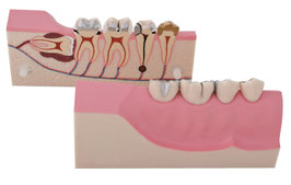 Zweiteiliges Molaren-Demonstrationsmodell