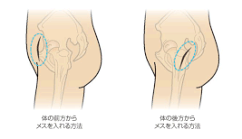 人工股関節置換術