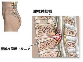 腰椎ヘルニア