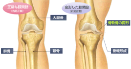 東京品川区の大井町駅前整骨院が得意とする変形性膝関節症