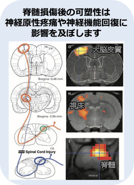 脊髄損傷後の可塑性は神経原生疼痛や神経機能回復に影響を及ぼします