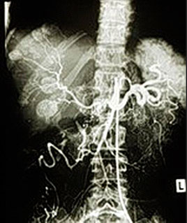 Röntgenbild eines Angiokatheters, der für eine arterielle Infusion zur regionalen Chemotherapie platziert wird, mit Kontrastmittel, das die Tumorregion visualisiert.