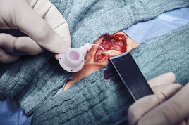 Chirurgischer Eingriff: Ein arterieller Portkatheter wird von Händen in OP-Handschuhen in eine offene Wunde eingesetzt.