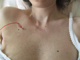 Oberkörper einer Patientin mit sichtbar implantiertem Portkatheter unter der Haut und angeschlossener arterieller Infusionsleitung.