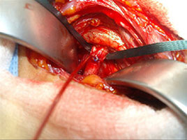 Blick auf einen arteriellen Subclavia-Katheter, bei dem die Katheterspitze in der Arterie liegt und der Port unter die Haut gesetzt ist, um einen bequemen Zugang für die intraarterielle Chemotherapie zu ermöglichen.