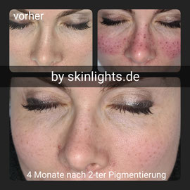 Collage B – vorher, direkt danach, 4 Monate nach 2. Behandlung