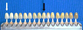 Mit einer Farbskala kann der Zahnarzt die Wirkung der Zahnaufhellung exakt messen