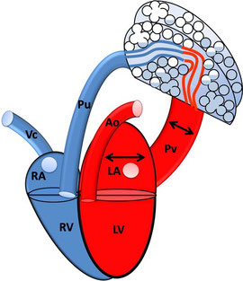 Links-Herzversagen: linkes Atrium und Pulmonalvenen sind gestaut, es besteht ein Lungenödem; RA: rechtes Atrium; RV: rechter Ventrikel; VC: Vena cava; Pu: Pulmonalarterie; LA: linkes Atrium; LV: linker Ventrikel; PV: Pulmonalvene; Ao: Aorta