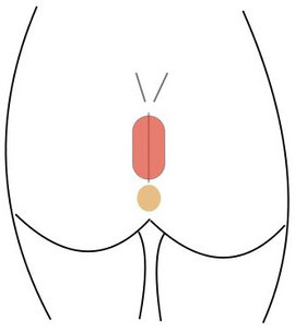 Steissbeinfistel (Sinus pilonidalis) Exzision