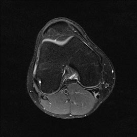 MRI Knie rechts 9.2.2012