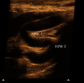 Ultrasound of the internal carotid artery with 2 kinks