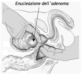 noduli adenomatosi alla prostata