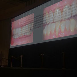 ERIC VAN DER WINDEN  "Achieving Strong and Natural Estheticswith cutback pressed crowns and veneers "