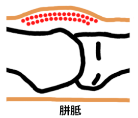 胼胝は全体的に皮膚が盛り上がっています