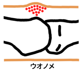 ウオノメは局所的に盛り上がり、中心に芯があります