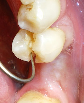toothache broken tooth