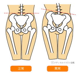 産後の骨盤は不安定なので腰痛や肩こり、頭痛の原因になります