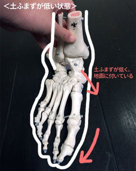 土ふまずが低くなると骨格上、親指が外を向きます