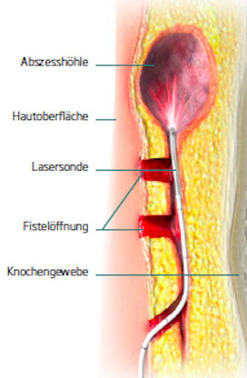 Laser OP bei Steissbeinfistel (Sinus pilonidalis)