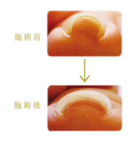 ニコ舎 巻き爪のばし 施術例