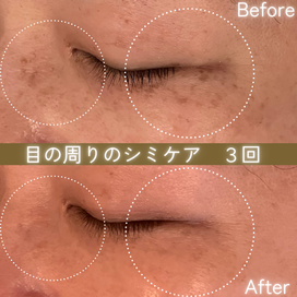 シミケアの効果　ビフォーアフター