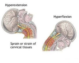 頸椎損傷,むちうち