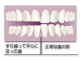 歯ぎしり