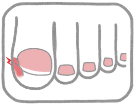 陥入爪のイラスト