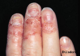 eczema du bout des doigts