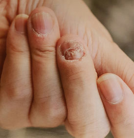 Geschädigter Nagel durch Verletzung, gefährdet für Infektion