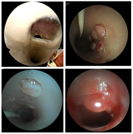Endoskopische Bilder von verlegten Phonationsöffnungen, unten rechts: Irritation im Tracheostomakanal nach Entfernung der Kanüle 