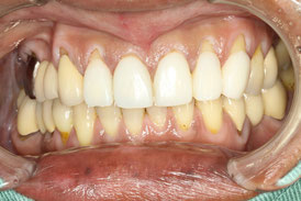 歯茎と審美歯科