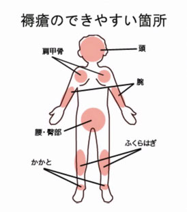 床ずれのできやすい箇所