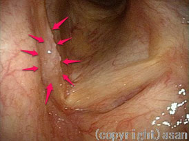 早期のの喉頭癌