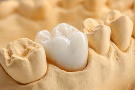 Präzise gearbeitetes Zahnmodell zeigt eine ästhetische Keramikkrone – hochwertige Restauration für natürlichen Zahnersatz.