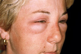 Angioedema