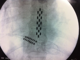 Radiographie d'une électrode chirurgicale de type "multicolonne"