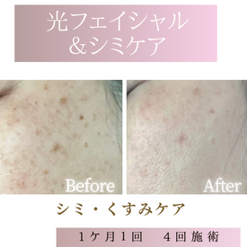 光フェイシャル　ビフォーアフター