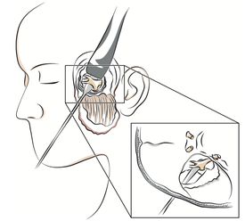 Intervention de neurotomie rétrogassérienne par voie sous-temporale