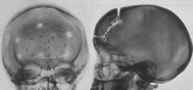 Clichés radiologiques post-topectomie
