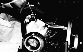 Installation d’un patient lors d’une hypophysiolyse par injection d’alcool avec mise en place d’un cadre de stéréotaxie et du trocart par voie trans-sphénoïdale