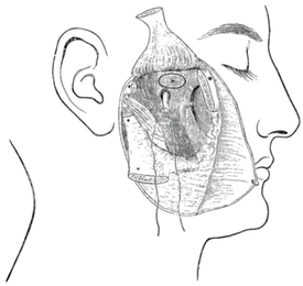 L’intervention de W. Rose permettant d’accéder au foramen ovale après dissection du nerf mandibulaire. Un fil traverse le nerf, le muscle temporal est récliné vers le haut tandis que l’arcade zygomatique l’est vers le bas 