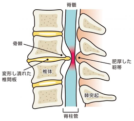 ぎっくり腰　鍼　整骨院　松戸　腰痛　整形外科　慢性腰痛　治療　はり トリガーポイント　鍼灸院　スポーツ