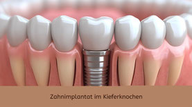 Implantologie - Zahnarztpraxis & Implantologie Dr. med. dent. Malte Uhrigshardt Tornesch im Kreis Pinneberg
