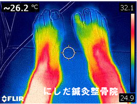 星状神経節レーザー照射