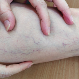 vàrices, úlceras, celulitis, estrías y piernas cansadas