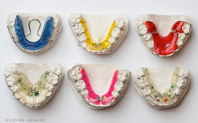 Herausnehmbare Zahnspangen werden vor allem bei Kindern und Jugendlichen eingesetzt.