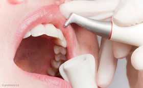 Zahnreinigung mit Pulverstrahlgerät