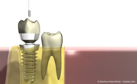 Implantate: Fest wie eigene Zähne